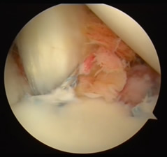 Rinforzo della sutura capsulare