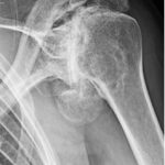 Esame radiografico di grave artrosi di spalla