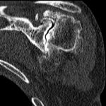 Esame Tc della spalla che mostra grave artrosi