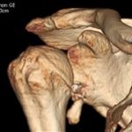 Altro caso di grave artrosi dopo Latarjet