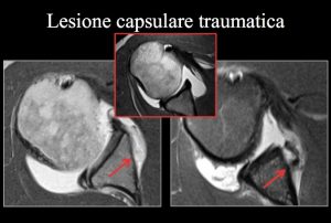 Lesione capsulare traumatica