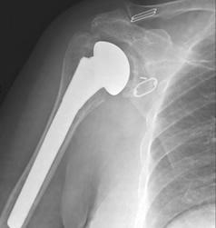 protesi inversa roma